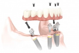 Tratamento com All-On-4